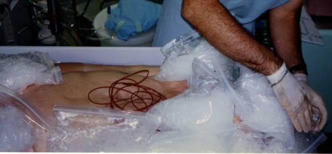 cryopreservation human